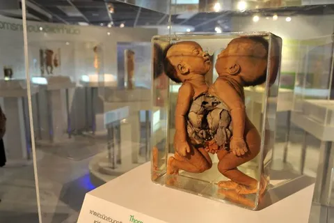 Destination: Siriraj Medical Museum — some awesome gruesomeness (NSFW) (Bangkok, Thailand) - Thailand -