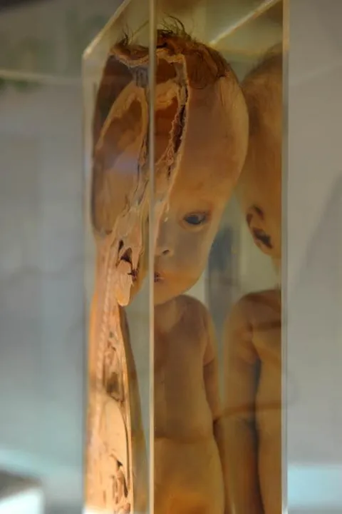 Destination: Siriraj Medical Museum — some awesome gruesomeness (NSFW) (Bangkok, Thailand) - Thailand -