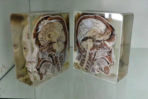 Destination: Siriraj Medical Museum — some awesome gruesomeness (NSFW) (Bangkok, Thailand) - Thailand -